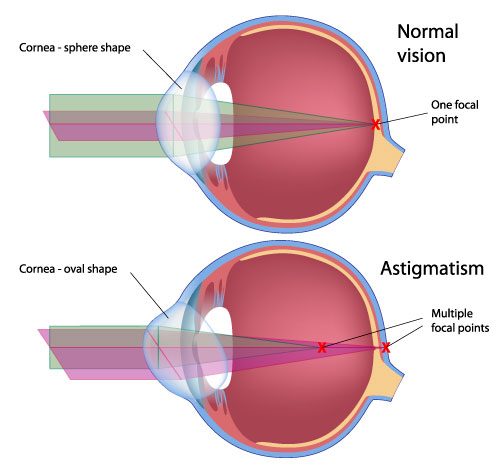Illustration of astigmatism