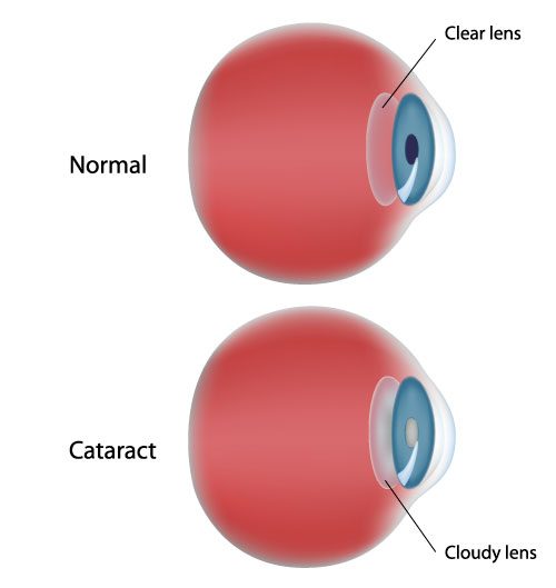 Illustration of a cataract