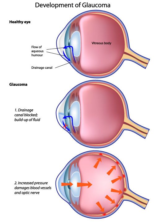Illustration of glaucoma
