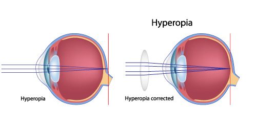 Illustration of hyperopia (farsightedness)