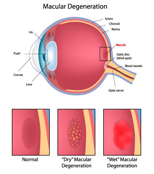 Illustration of macular degeneration