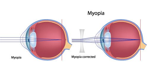 Illustration of myopia (nearsightedness)