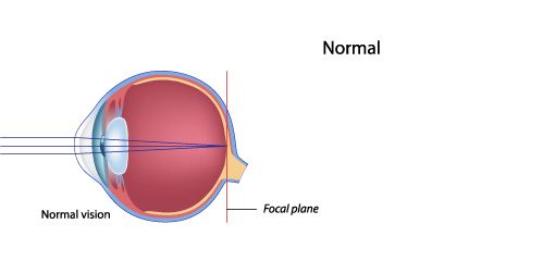 Illustration of normal vision