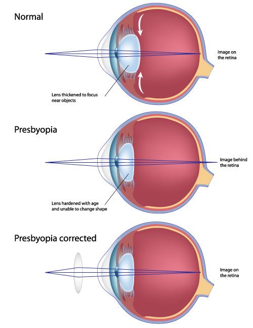 Illustration of presbyopia