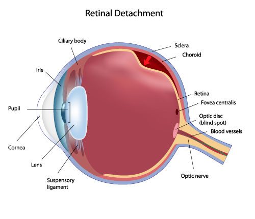 Illustration of a retinal detachment