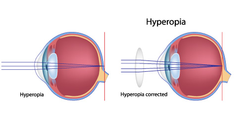 illustration_hyperopia