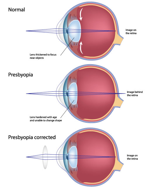 illustration_presbyopia